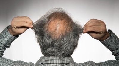 탈모는 이제 세계적 고민, 두피 관리 산업 급성장
