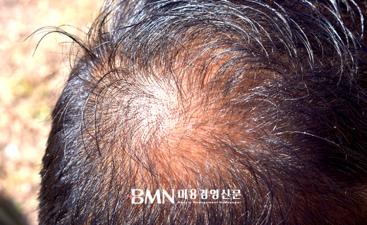 &#034;여름철 습도·땀이 두피 공격한다&#034;... 높은 온도·습도, 피지 분비 급증으로 탈모 위험