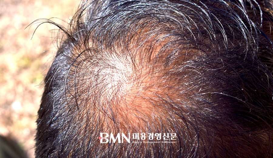&#034;여름철 습도·땀이 두피 공격한다&#034;... 높은 온도·습도, 피지 분비 급증으로 탈모 위험